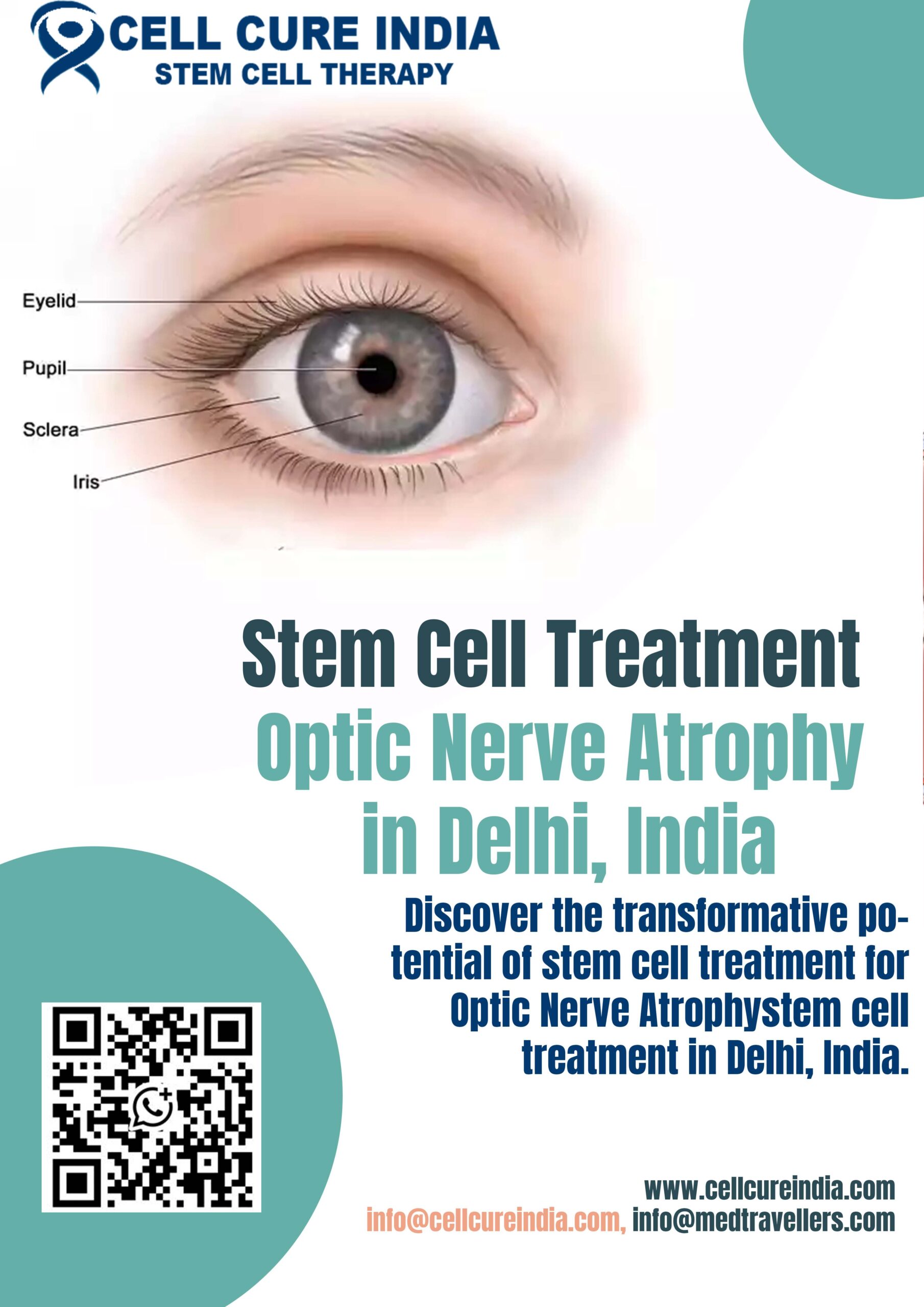 Optic Nerve Atrophy Stem Cell Treatment in India